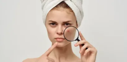 causes acne